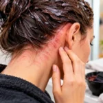 Alergia al tinte de cabello: síntomas, causas y qué hacer Alergia tintes de cabello