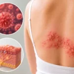 Herpes zóster (culebrilla): síntomas, causas, tratamiento y cuánto dura Herpes zóster (culebrilla)