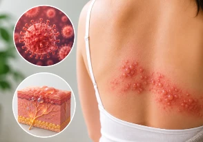Herpes zóster (culebrilla)