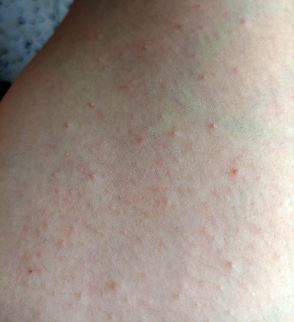 Tratamientos para Queratosis Pilaris La Queratosis pilaris causas y tratamientos