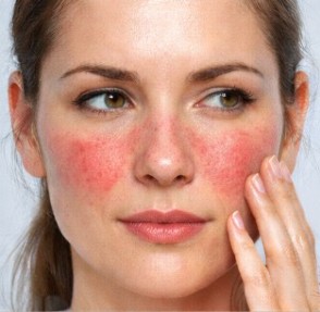 Tipos de rosacea