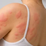urticaria causas y tratamiento