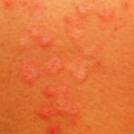 Pitiriasis versicolor: causas y soluciones pitiriasis versicolor