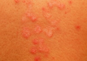 manchas por hongos en la piel cuello espalda hombros