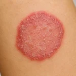 Dermatitis Numular: manchas redondas que pican Dermatitis numular