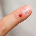Granuloma piogeno