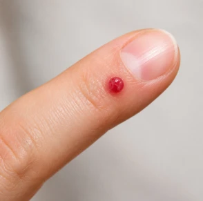 Granuloma piógeno