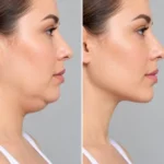 Liposuccion de papada