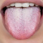 Lengua blanca: causas más frecuentes y qué significa Lengua blanca causas
