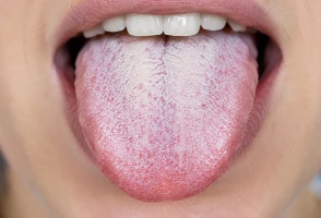 Lengua blanca causas
