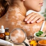 Vitiligo causas y tratamientos