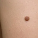Nevus melanocítico