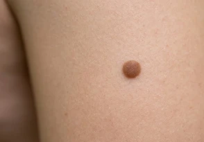 Nevus melanocítico