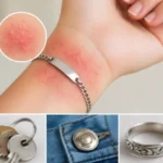 Alergia al níquel: síntomas, causas, tratamiento y cómo evitarla Alergia al niquel