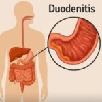 Duodenitis