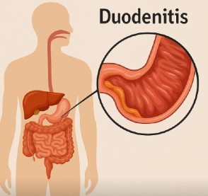Duodenitis: causas, síntomas y tratamiento