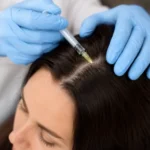 Mesoterapia capilar para la caída del cabello Mesoterapia capilar