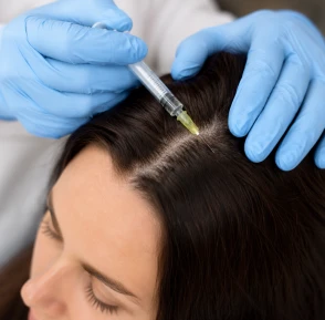 Mesoterapia capilar para la caída del cabello
