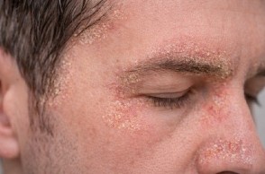 Remedios naturales para la Dermatitis Seborreica