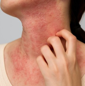 Dermatitis atópica