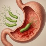 Gastritis causada por Helicobacter pylori Gastritis causada por Helicobacter pylori