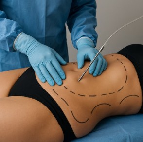 Efectos secundarios y riesgos de la liposucción