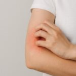 Dermatitis alérgica Dermatitis alergica