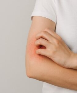 Dermatitis alérgica