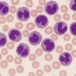Glóbulos blancos altos: causas frecuentes y qué significan Globulos blancos elevados