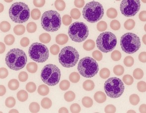 Glóbulos blancos altos en un examen de sangre