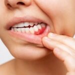 La Periodontitis aumenta el riesgo de infartos