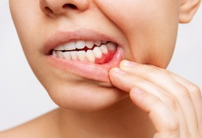 La Periodontitis aumenta el riesgo de infartos