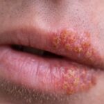 Herpes simple: qué es, síntomas, tipos y tratamientos Herpes simple