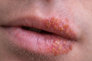 Herpes simple