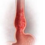 Esofagitis síntomas y causas
