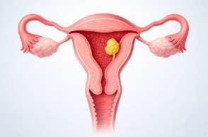 Pólipo endometrial y dificultad para lograr embarazo