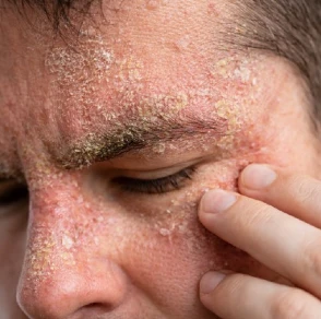 Síntomas de Dermatitis seborreica