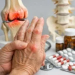 Artritis reumatoide