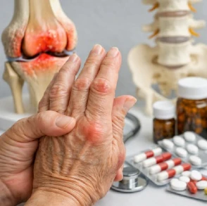 Artritis reumatoide
