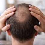 Alopecia androgénica: causas y tratamientos que funcionan Alopecia androgenetica