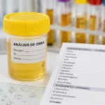 Cristales de oxalato de calcio: qué significa Oxalato de calcio en orina