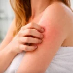 Picazón en el cuerpo después de bañarse: causas y soluciones Picazon cuerpo despues ducha