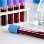 Valores normales de sodio en sangre