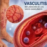 Vasculitis: qué es y síntomas principales Vasculitis