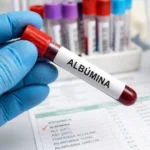 Analisis de Albúmina en sangre Albúmina baja o Hipoalbuminemia