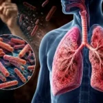 ¿Qué es la tuberculosis y cómo se contagia? Síntomas y tratamiento Tuberculosis