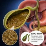 Lodo biliar: qué es, síntomas, causas y tratamiento Lodo biliar
