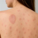 Pitiriasis rosada: síntomas, causas y tratamiento Pitiriasis rosada