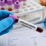 Ceruloplasmina