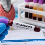 Tiroglobulina alta o baja: qué significa Tiroglubina analisis resultados